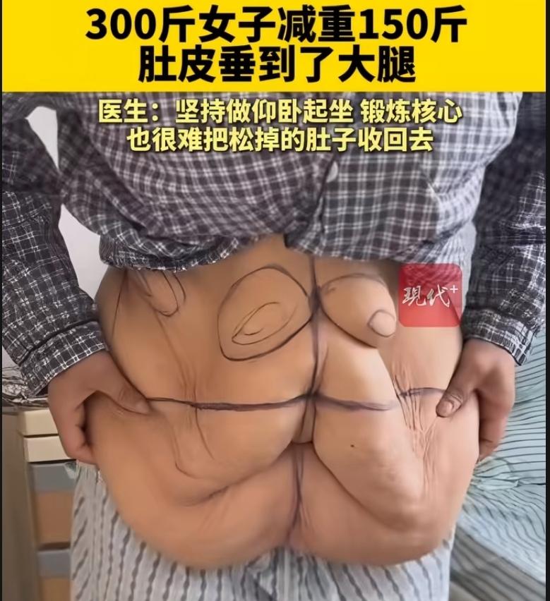 杨女士，300斤，减掉150斤，相当于减掉了半个自己。体重下来了、健康改善了，可