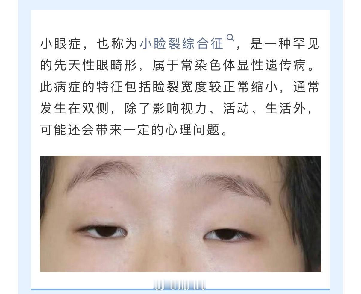 遗传了小睑裂综合征的孩子问父母：为什么要生我？父亲有这么明显的遗传病，却在没有干
