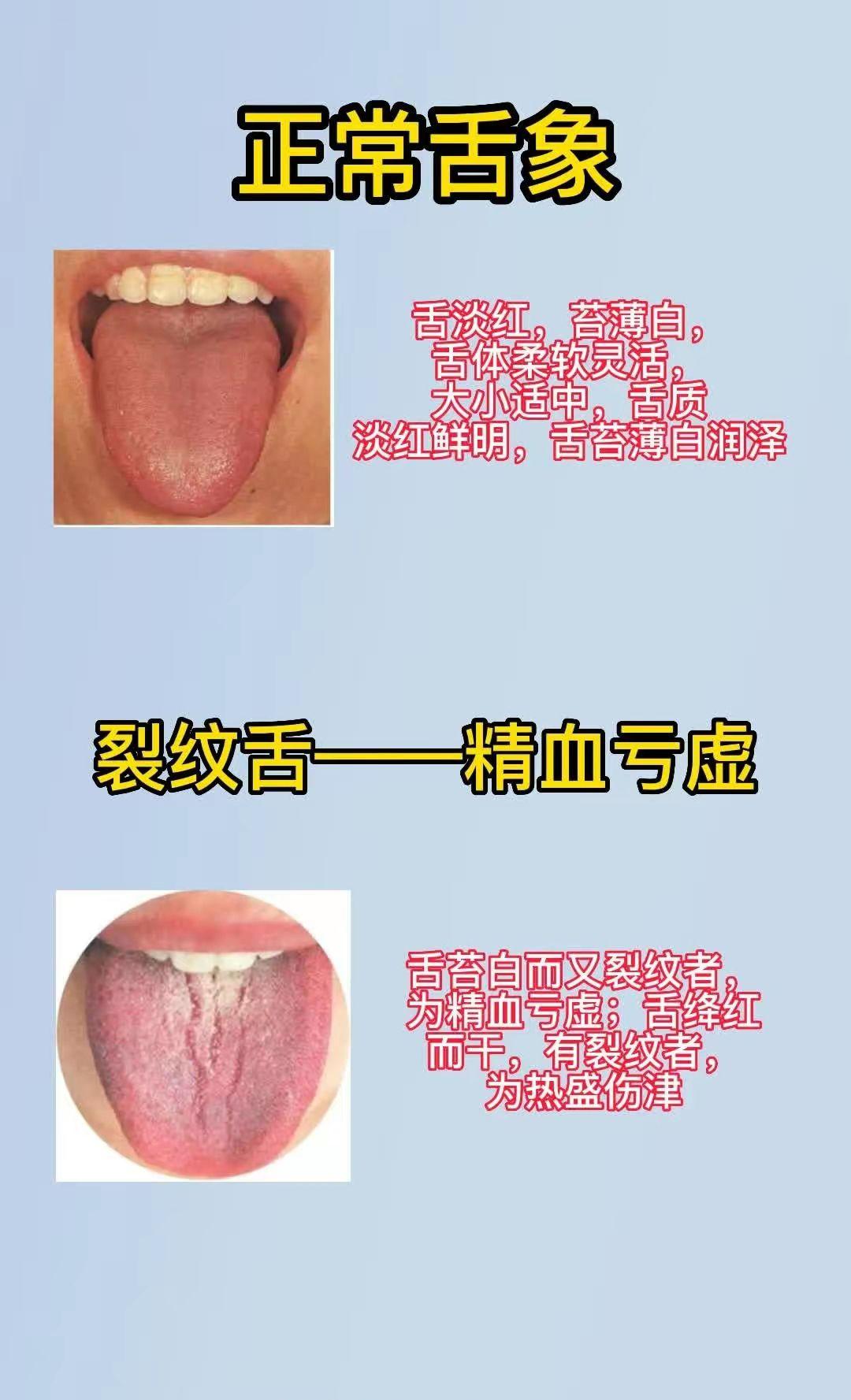 舌象分析 ：留下舌象 挨个讲讲