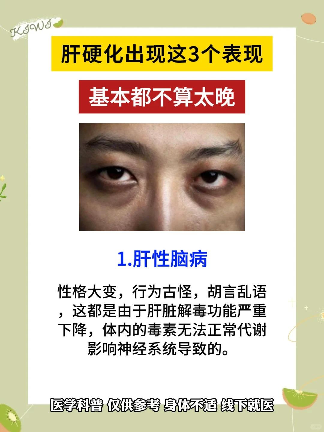 肝硬化的3个表现