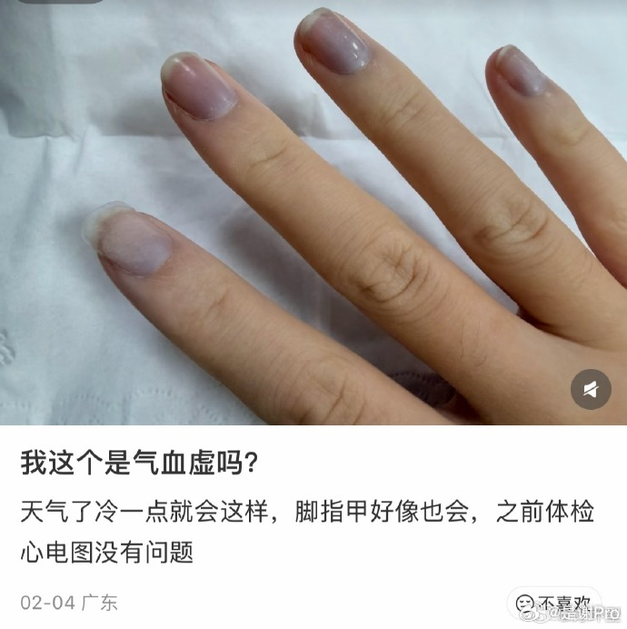 没见过气血虚成这样的 我还以为这是她做的美甲   看看心脏吧，真的 