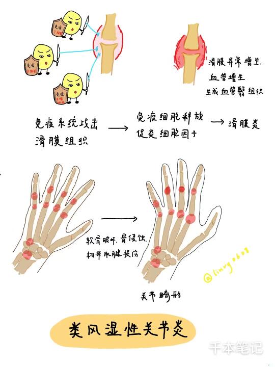 医学生绘本🎨第92弹【类风湿关节炎】