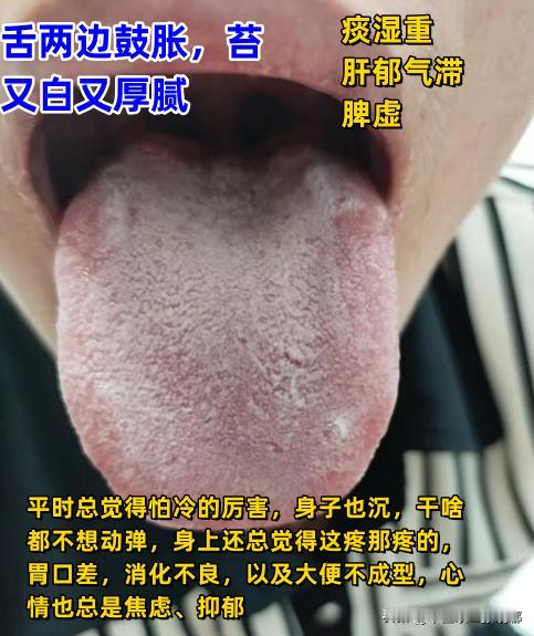 今日舌诊案例分析[给力][给力][给力]
1.舌两边鼓胀，苔又白又厚腻——说明痰