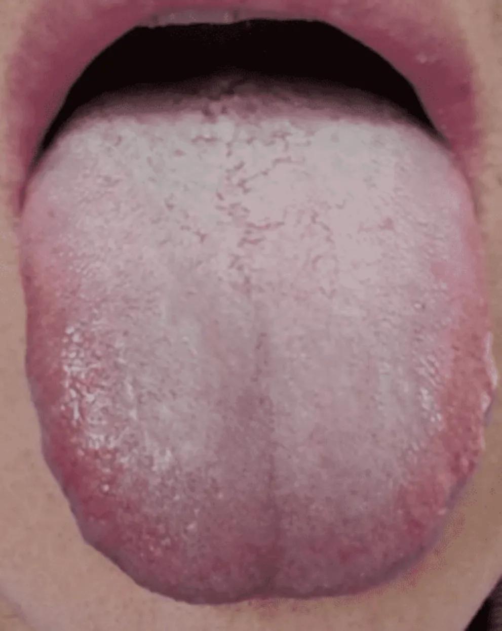 看舌头，猜情况，看看大家能猜出他是什么情况？

往下给大家揭晓答案，看看大家跟我