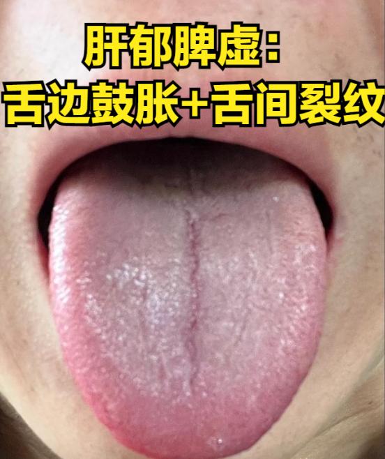 肝郁的四种情况，你是哪一种？教你一次分清，以及如何用药

①肝郁脾虚——舌两边鼓