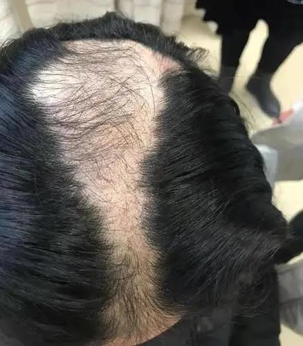 肾虚掉发？别干着急了，我来给你支几招

肾虚掉头发是许多人都面临的问题，而中医认