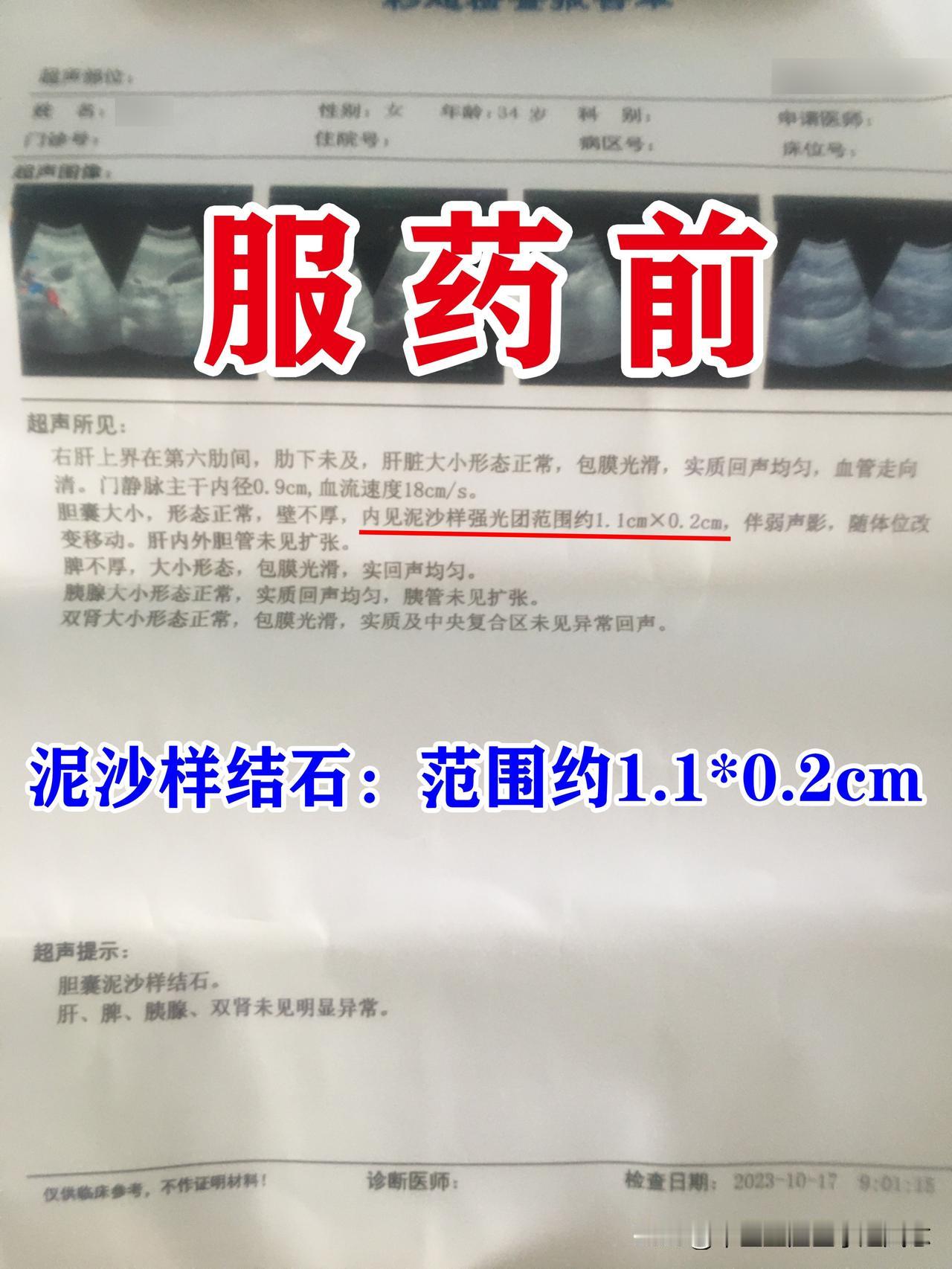 林女士因为胃脘部经常的隐痛，以为是胃的问题，吃了一些治疗胃的药，效果不好，去做个