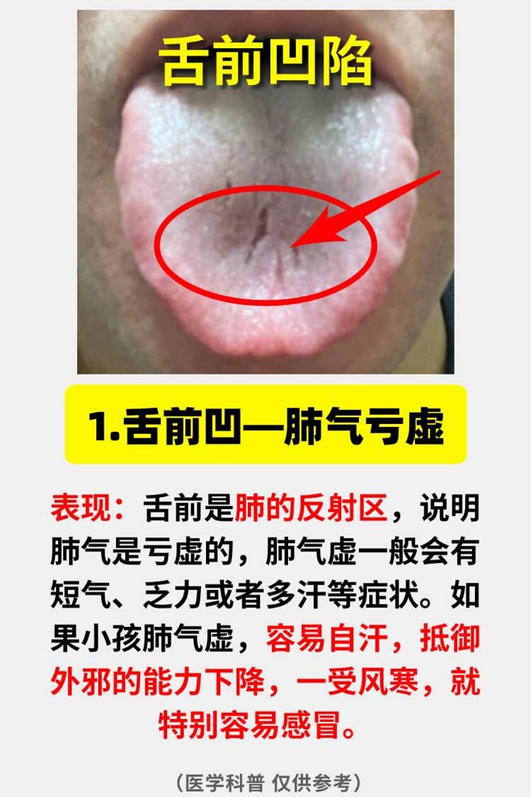 脾气虚，肺气虚，肾气虚，看一眼舌头就知道！
1、舌前凹一肺气亏虚
表现：气短乏力
