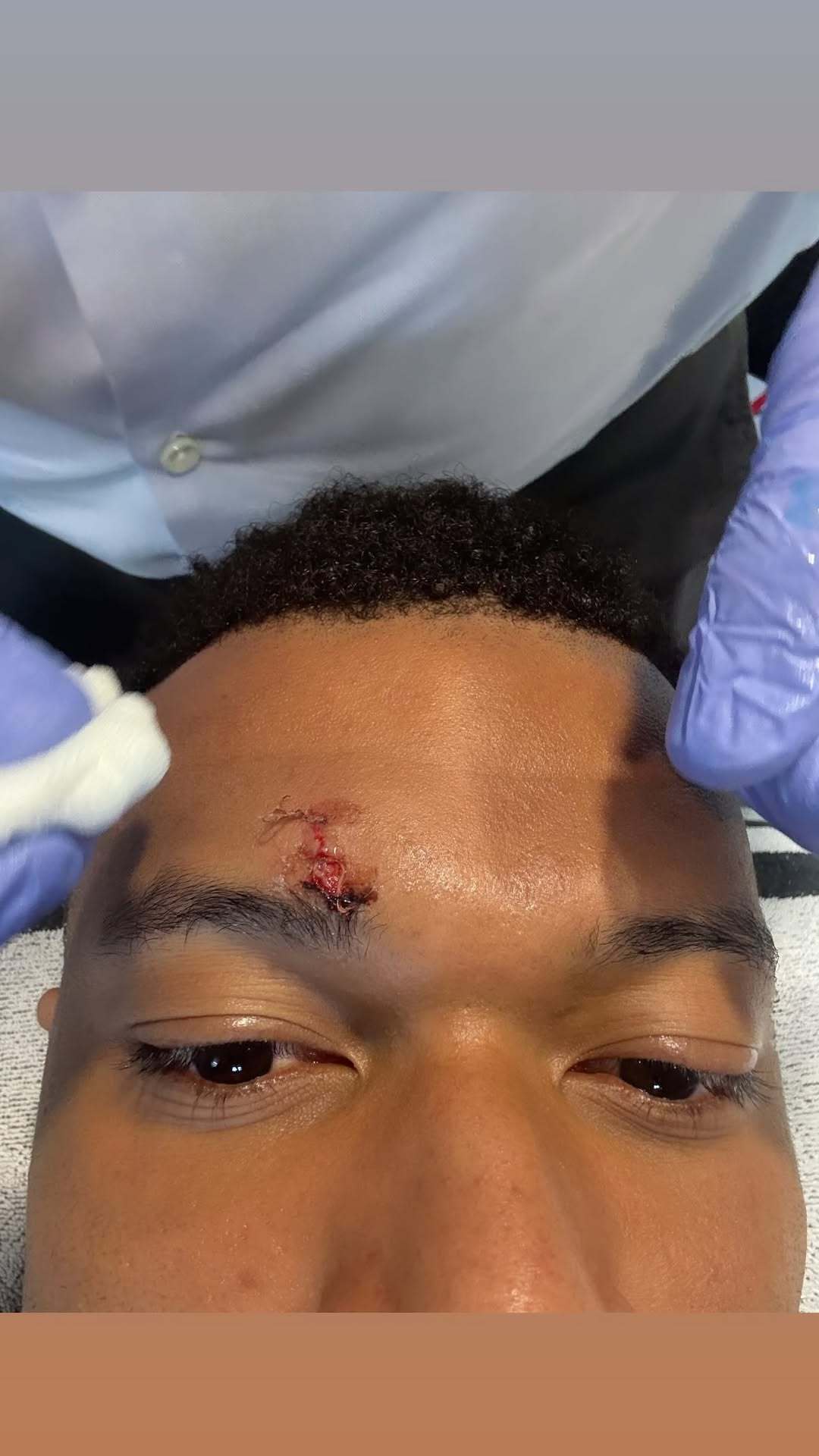 姆巴佩IG晒出了自己的缝针照 