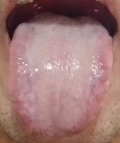 肝肾不足叠加湿郁气滞，如何改善宗筋失养问题






粉丝留言：近一年身体接连