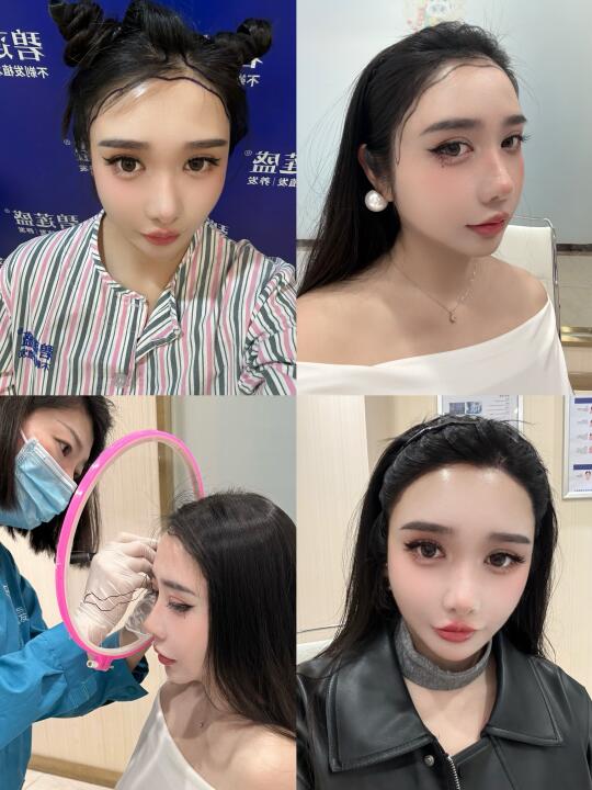 不剃发植发五天记录！我才知道的事...