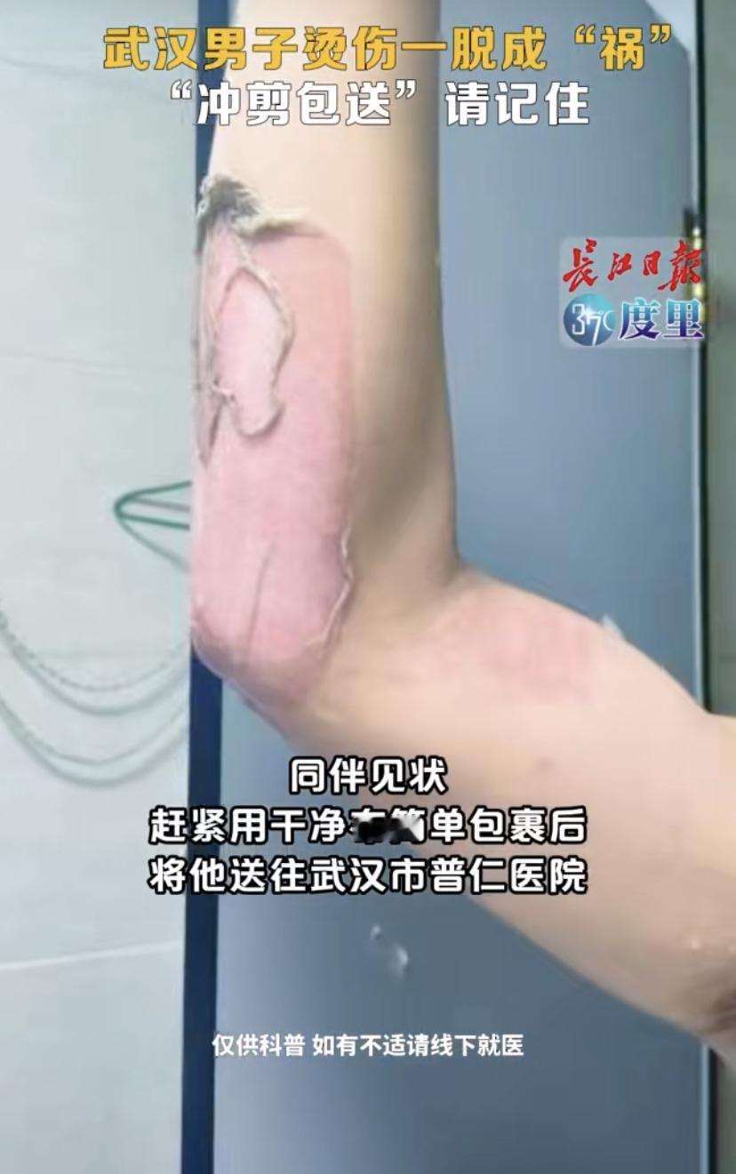 前几天在武汉，有个大哥不小心被开水烫着，一慌神，急着把衣服往下扯，结果连皮带肉撕