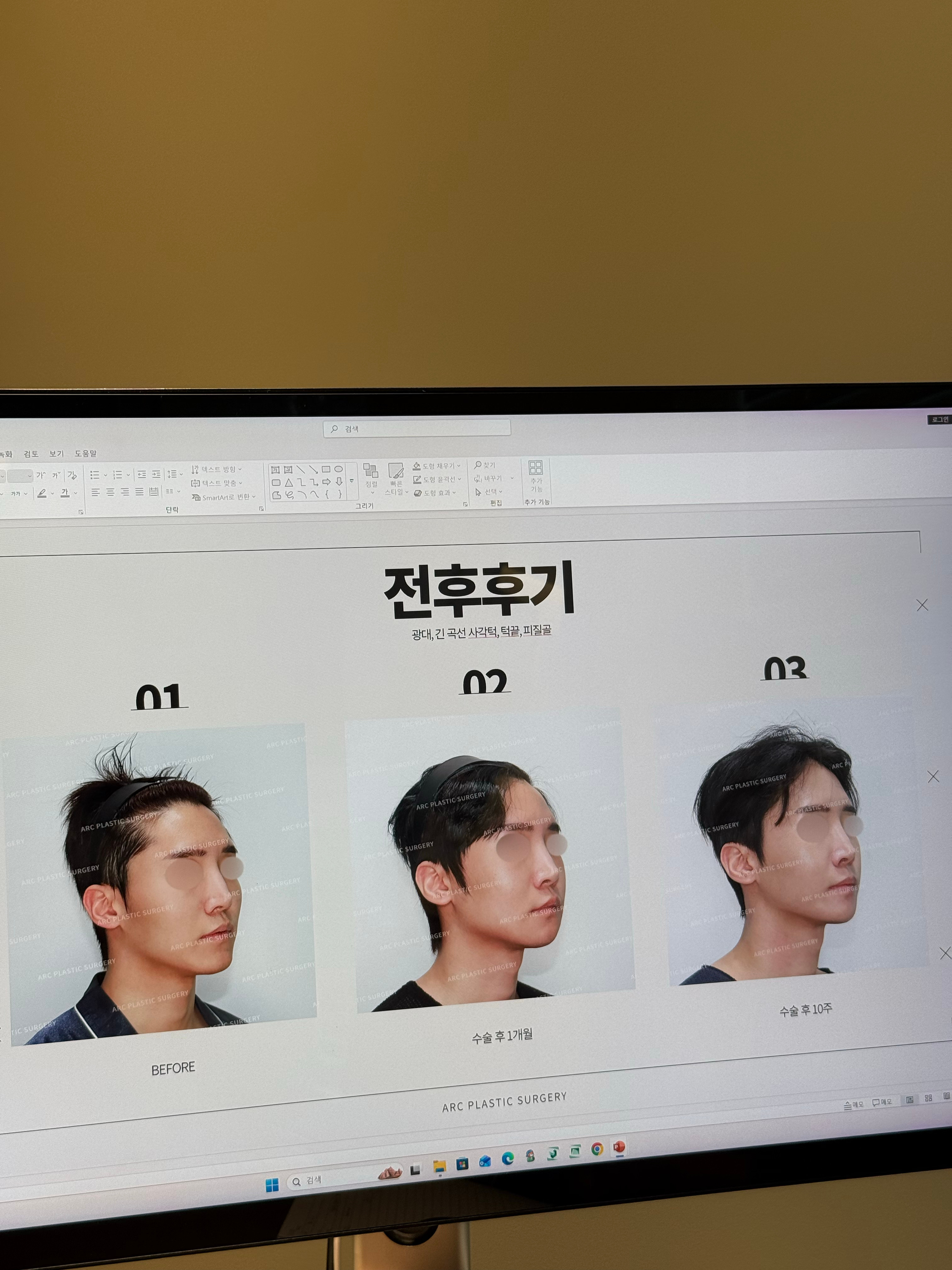 羡慕现在做轮廓的人，韩国轮廓现在都留角的诶。而且男性做轮廓完全！看不出来！上次和