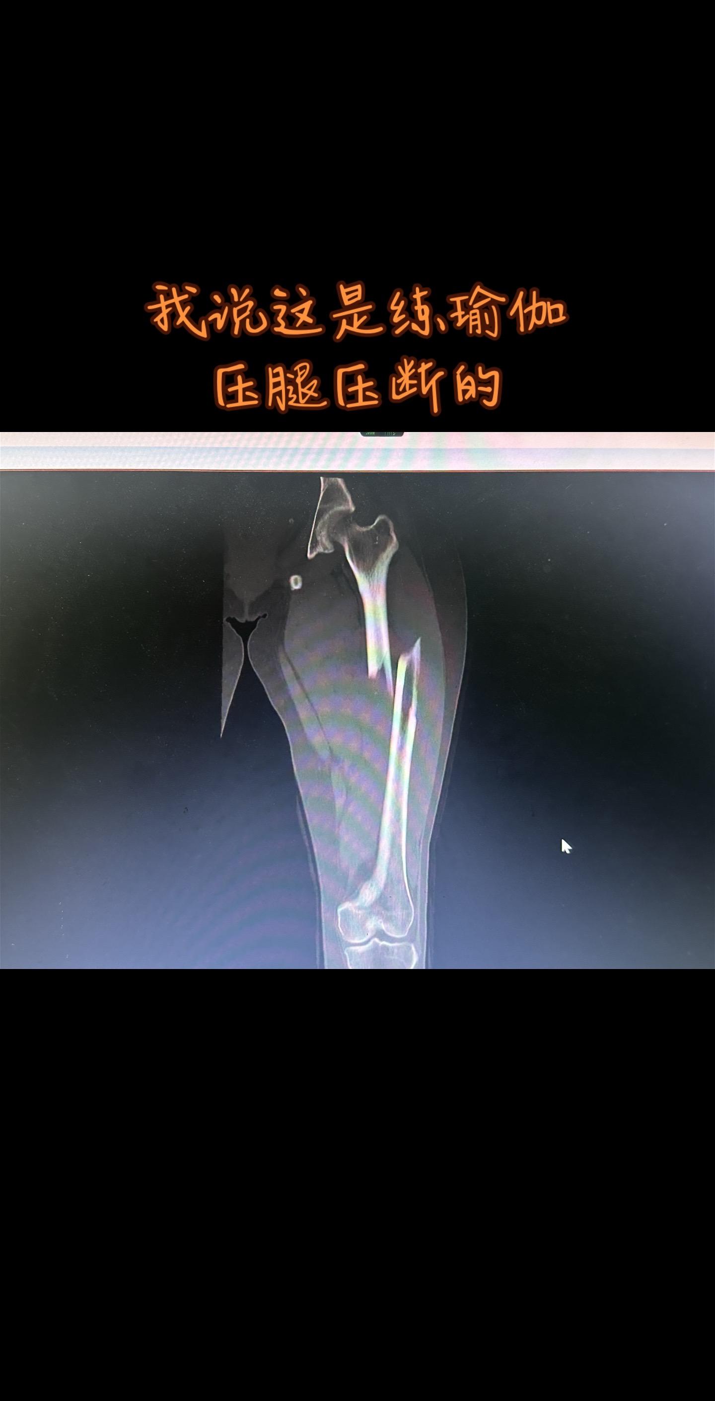 一些门诊见的骚操作。练习瑜伽 练骨折了