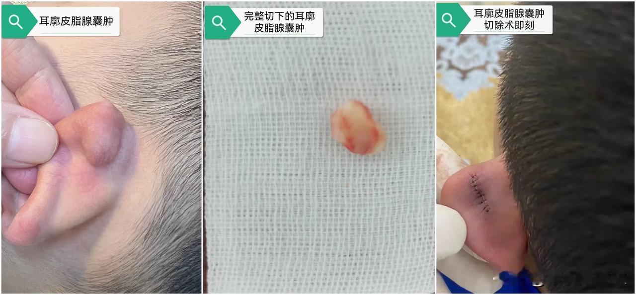 #夏日生活打卡季#

感谢医学专家同学的信任，带5岁孙子从成都来康明诊所做耳廓囊