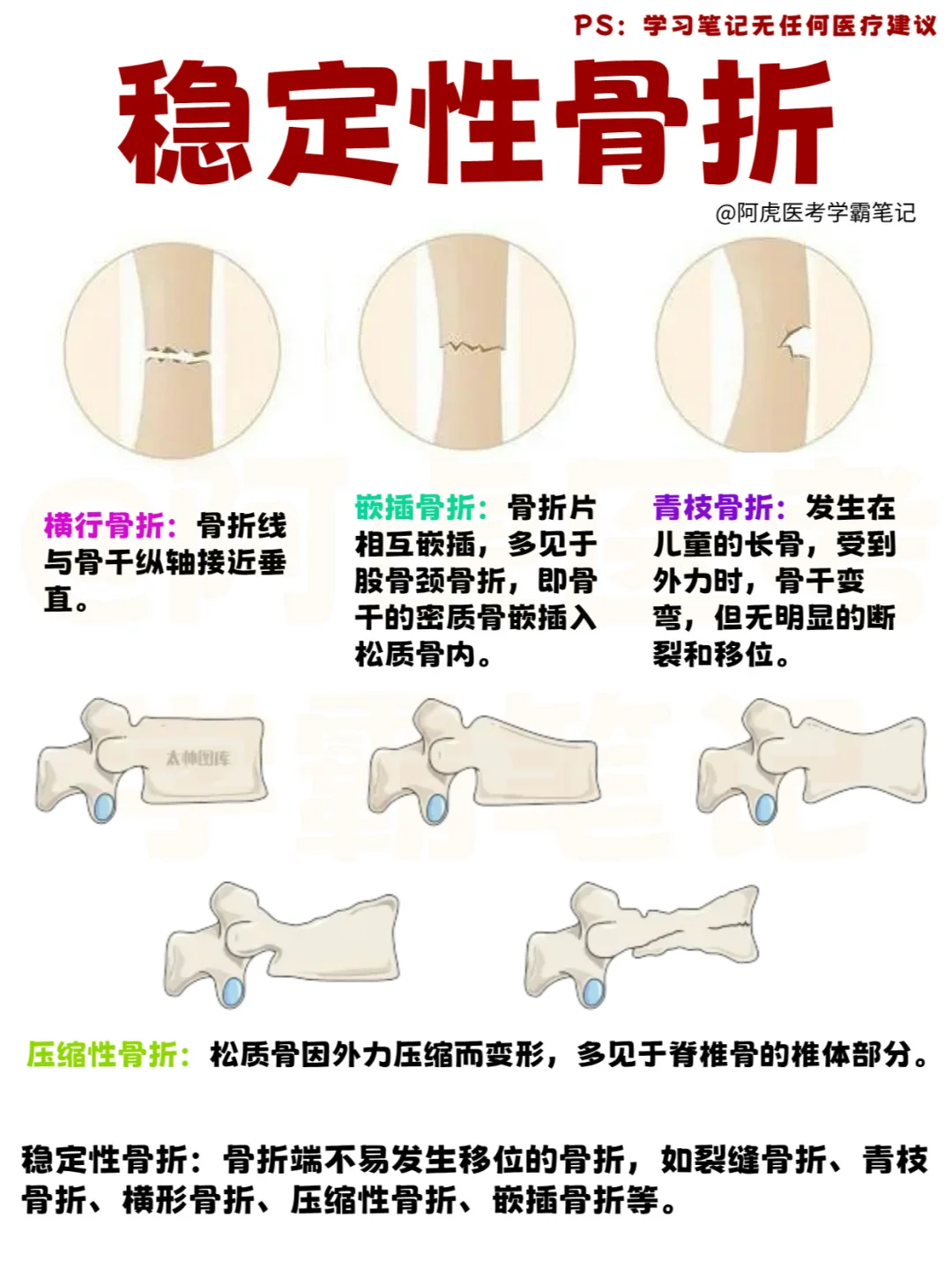 医学生笔记📒｜稳定性骨折👆