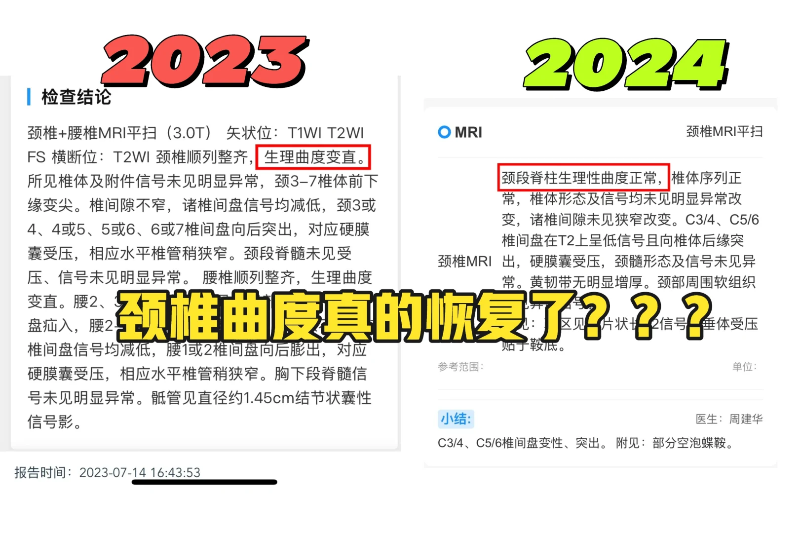 颈椎曲度真的可以恢复？