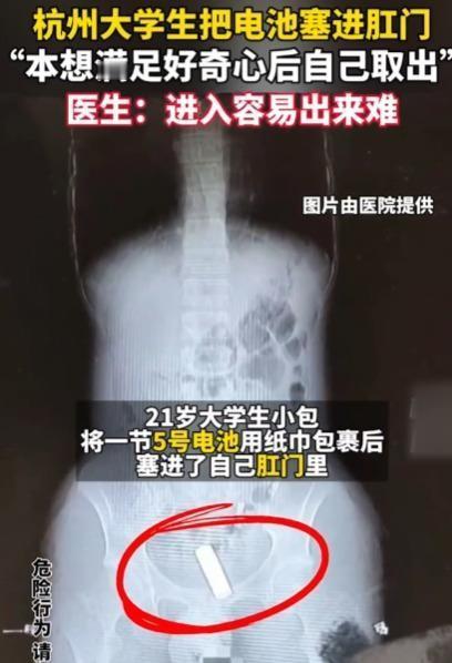 杭州一名21岁大学生因好奇心作祟，把5号电池塞进了肛门，结果取不出来，差点酿成大
