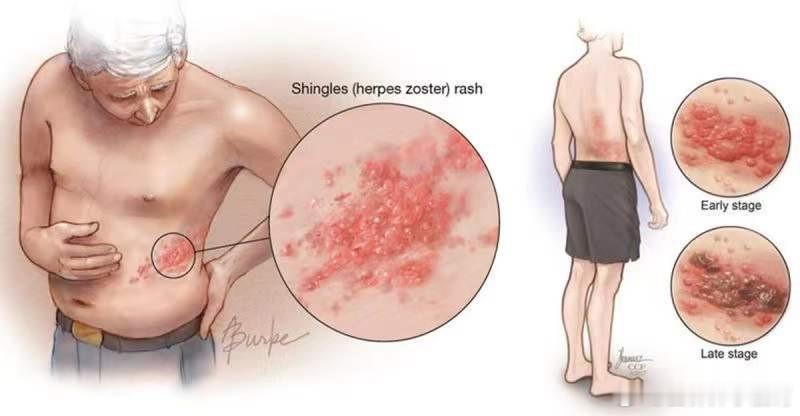 人不会无故患上带状疱疹这些苗苗至关重要 引起带状疱疹感染的病毒，其实就是我们小时