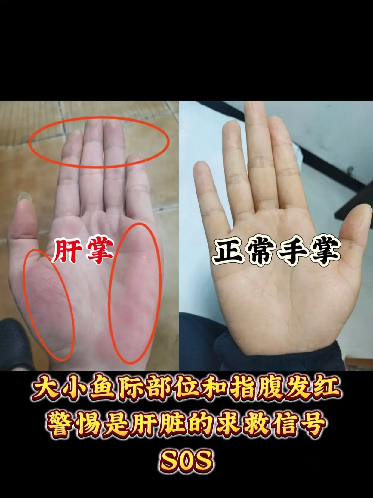 肝脏的求救信号之一——肝掌。
