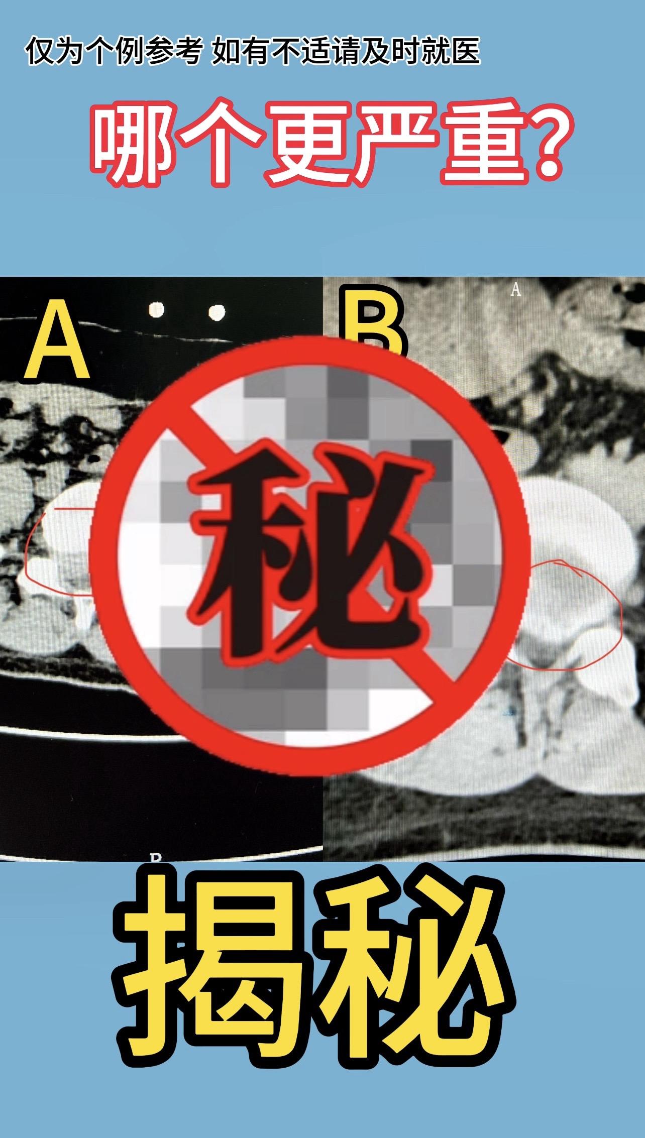 揭秘：大家可以看到其实第一个突出压迫更重，但病人症状较轻，保守治疗即可...