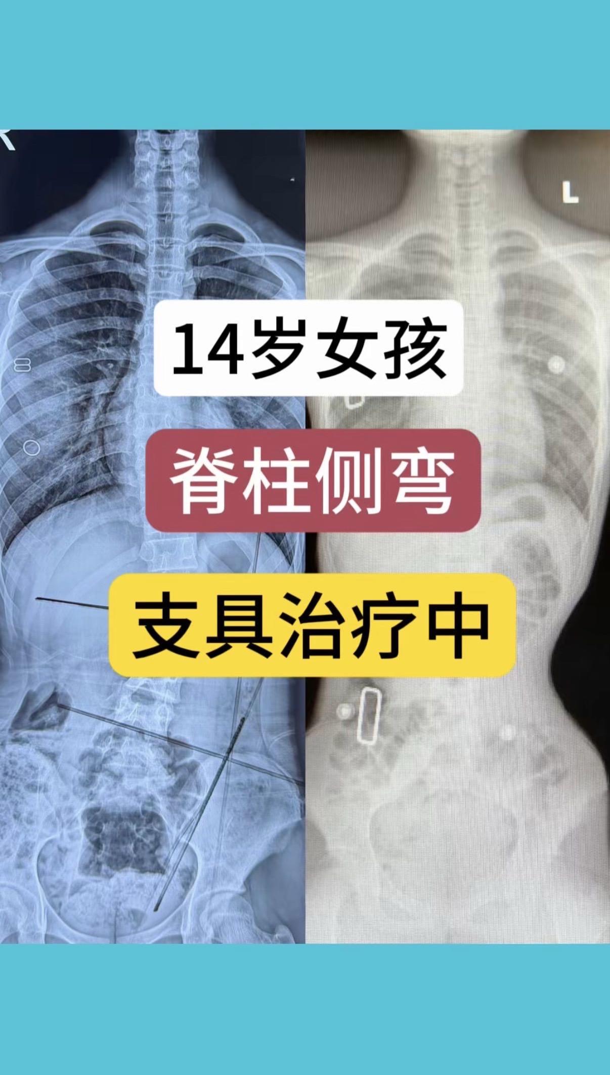 14岁女孩脊柱侧弯，支具治疗中。