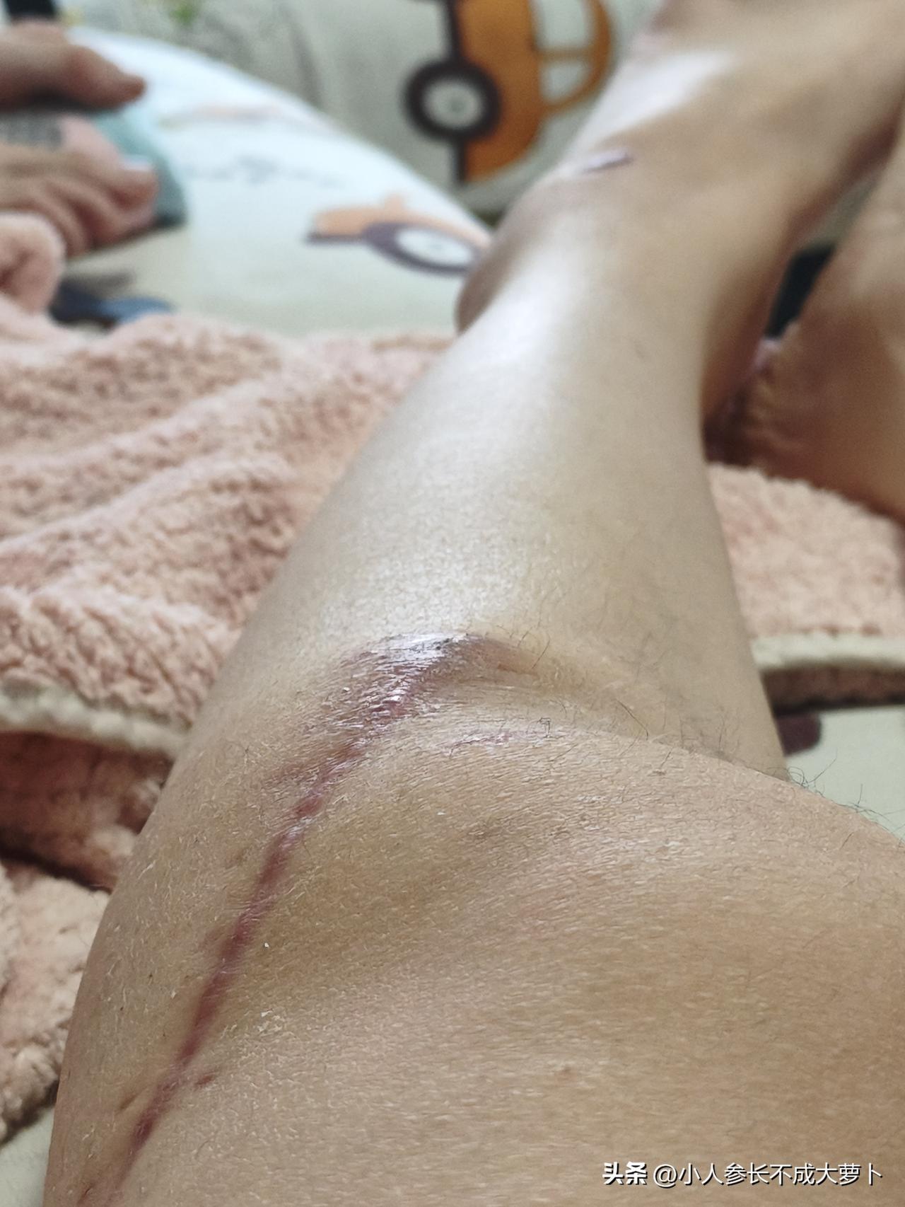 6月1号下班路上被撞骨折，生活发生了翻天覆地的变化，刚开始骨折的时候，我当时还不