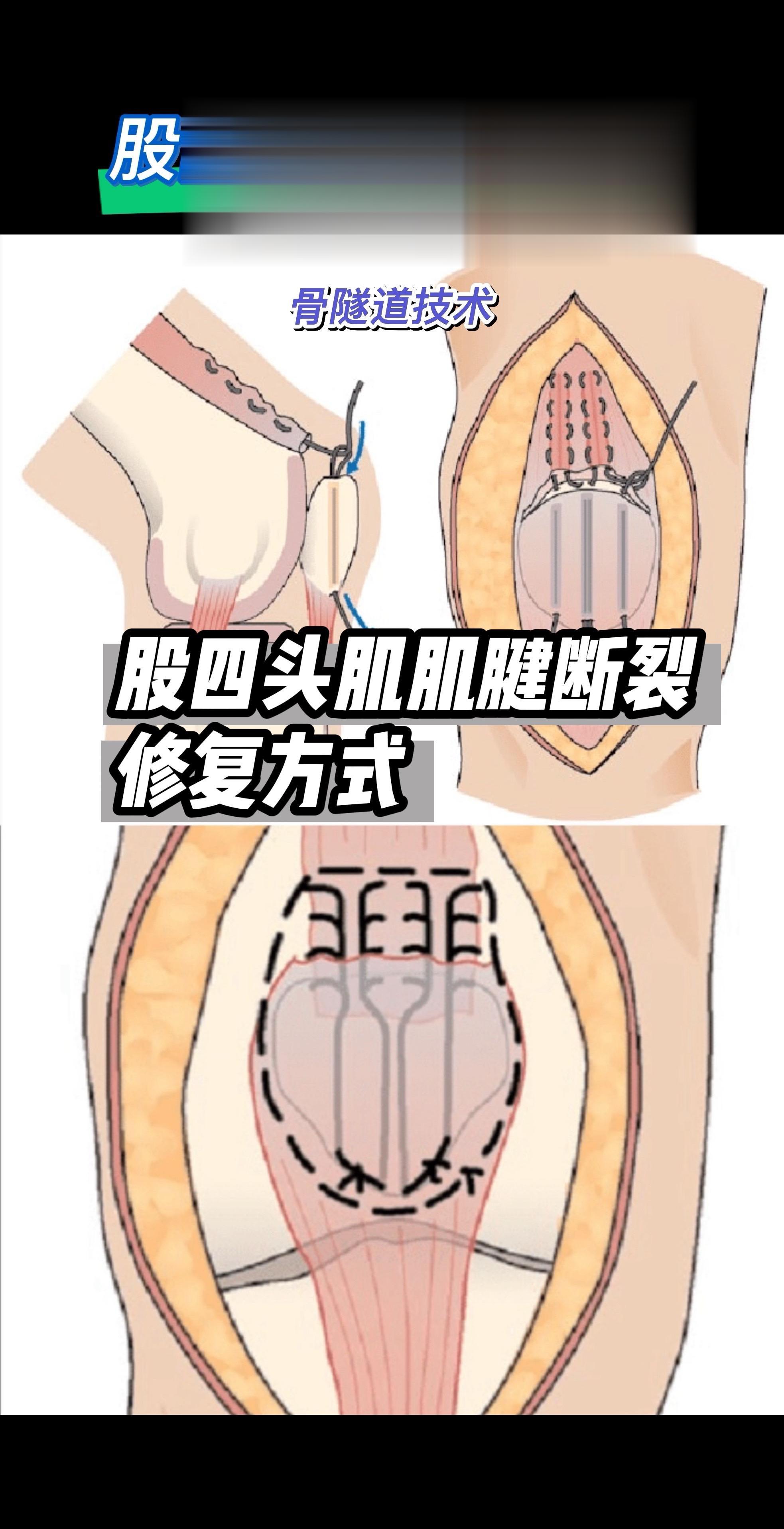 股四头肌肌腱断裂修复。