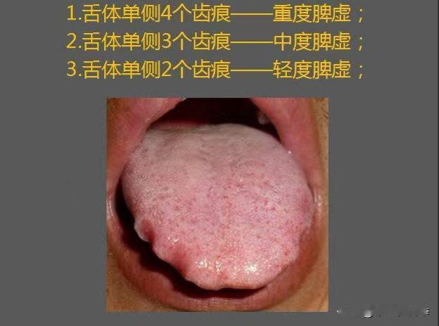 光知道齿痕舌是脾虚？寒湿、湿热、气虚怎么分？一次讲清楚
#中医##养生##舌象#