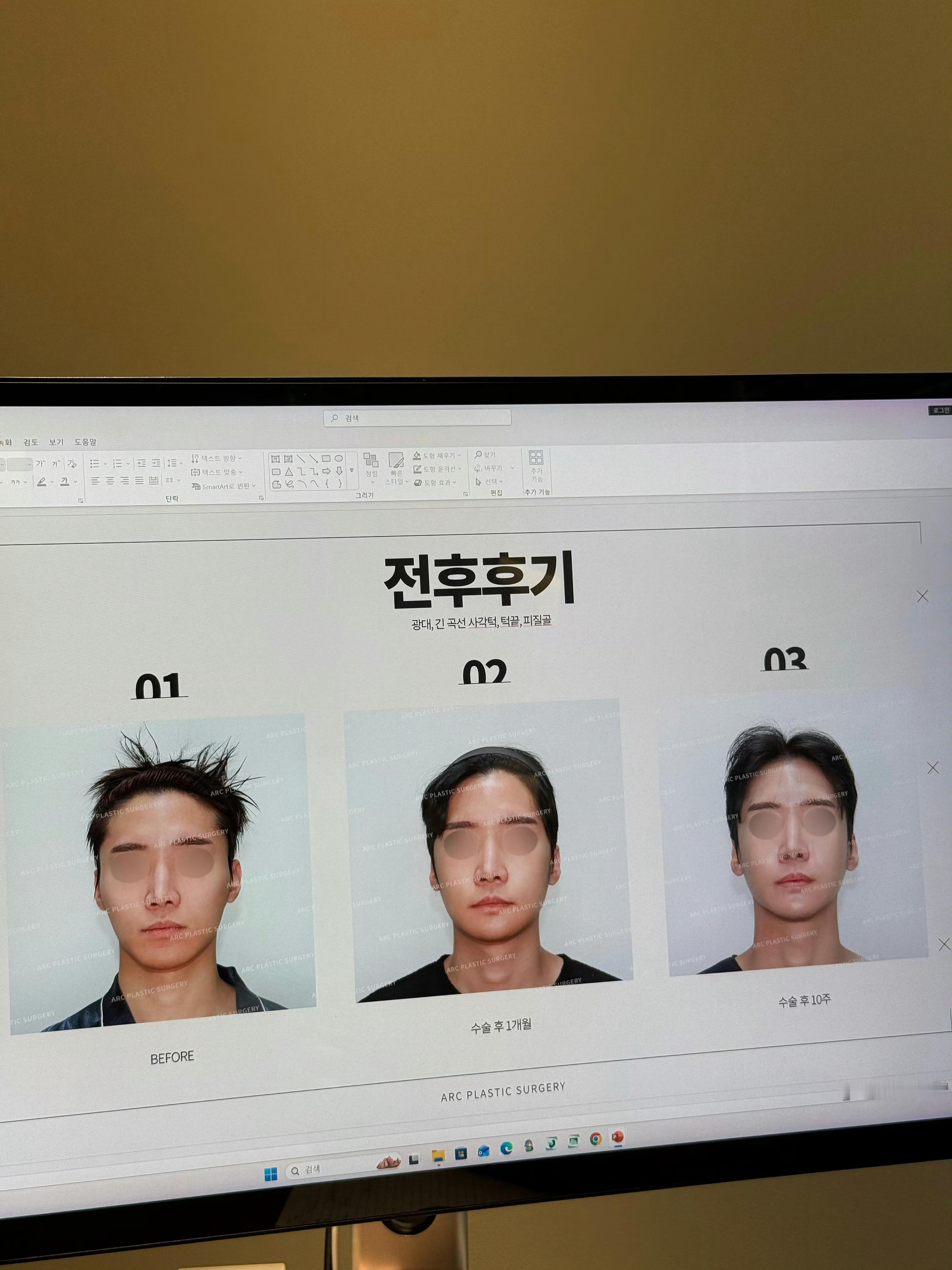 朋友那里看到的韩国轮廓整形对比。感觉第一个男的做完轮廓从直男变亩0️⃣第二个看不