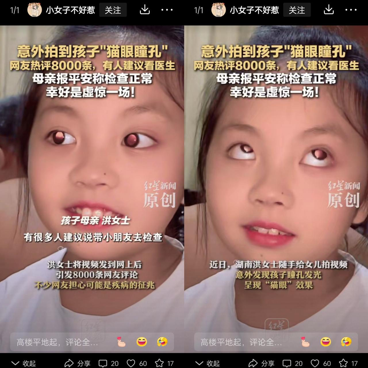 彻底解释不清了！湖南一位妈妈随手给女儿拍视频，竟发现孩子眼睛是“猫眼瞳孔”，发上