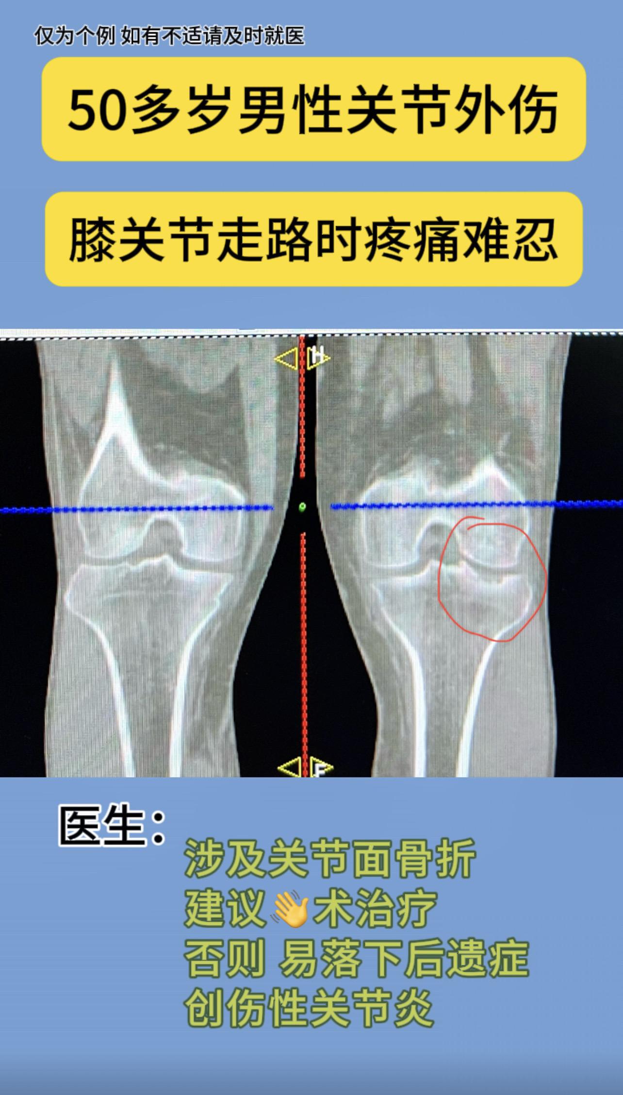 50多岁男性关节外伤后八个月，走路时膝关节疼痛难忍。
刚哥提醒：涉及关节面的骨折，建议👋术治疗，保守治疗效果较差，很容易落下后遗症——创伤性关节炎膝关节