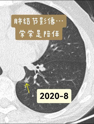 肺结节影像诊断，总是在安慰，常常是陪伴