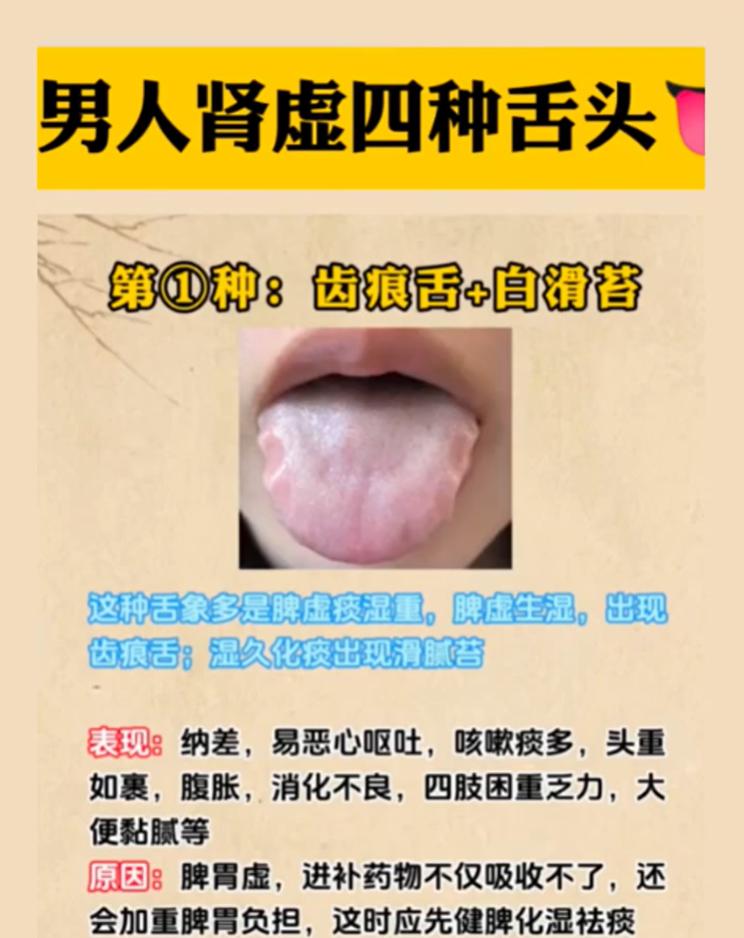 看舌辨体质：4 种舌象，告诉你为什么进补没效果