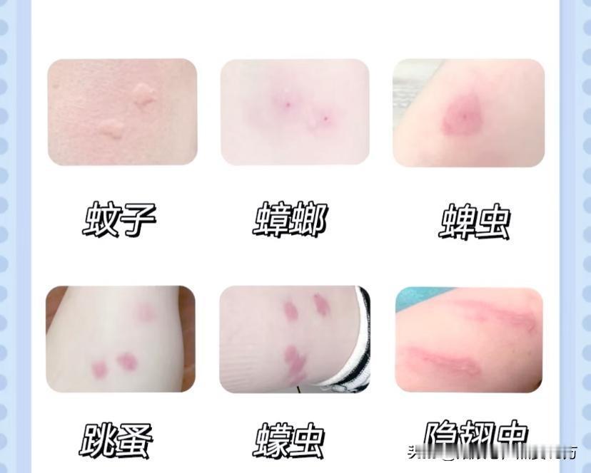 我给爷爷看了三亚旅游女孩被蛇咬身亡的新闻，爷爷告诉我，
她说被虫子咬了顶多肿个包