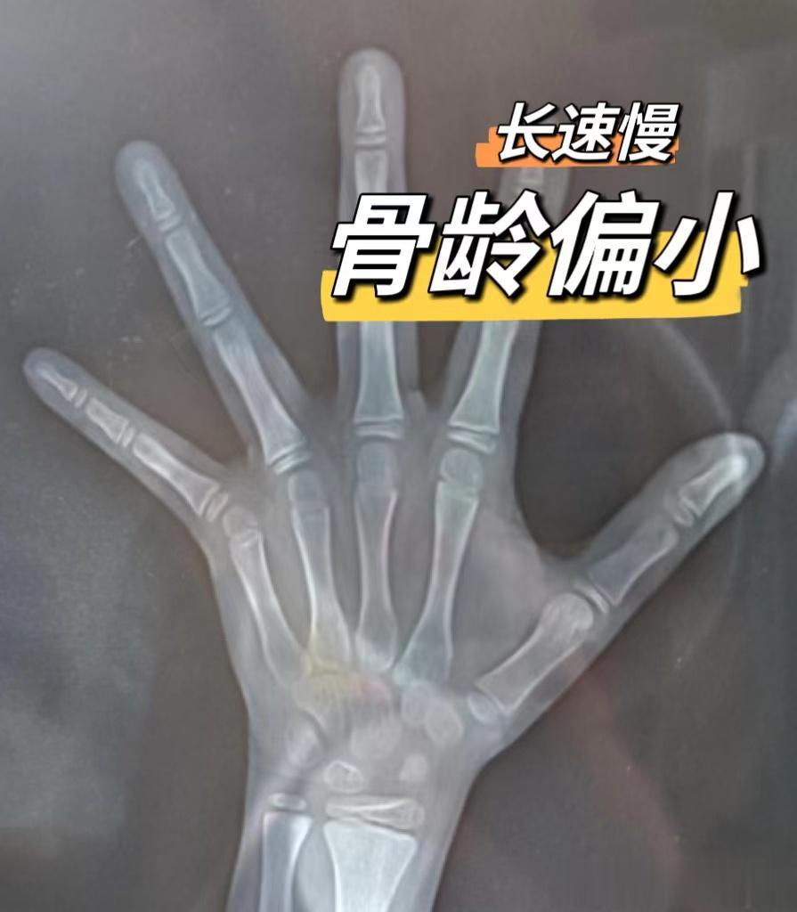 这是一个9岁男娃的骨龄片，骨龄在8.5岁左右。
 
▶孩子眼袋很重，4年过敏性鼻