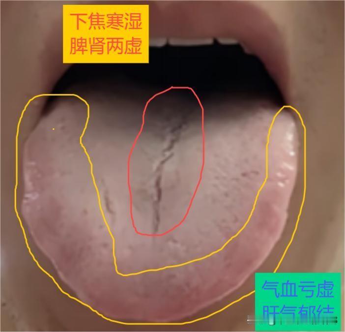 裂纹深重、男人快而不乐，再健脾也没啥用！

情况：翘不起来、挺不进去，“二弟”不