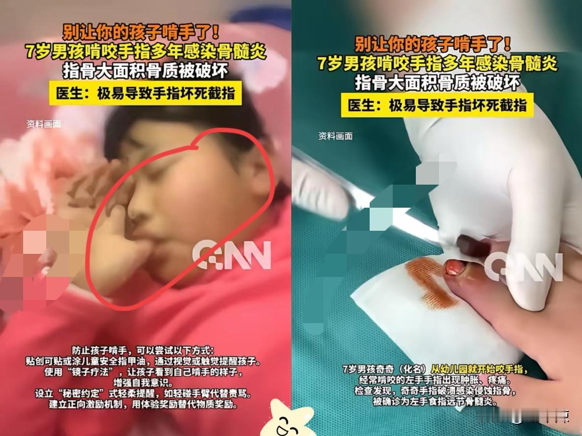 湖南，一男孩喜欢咬手指，他的妈妈尝试过各种方法都没能改掉他这个习惯，久而久之也就