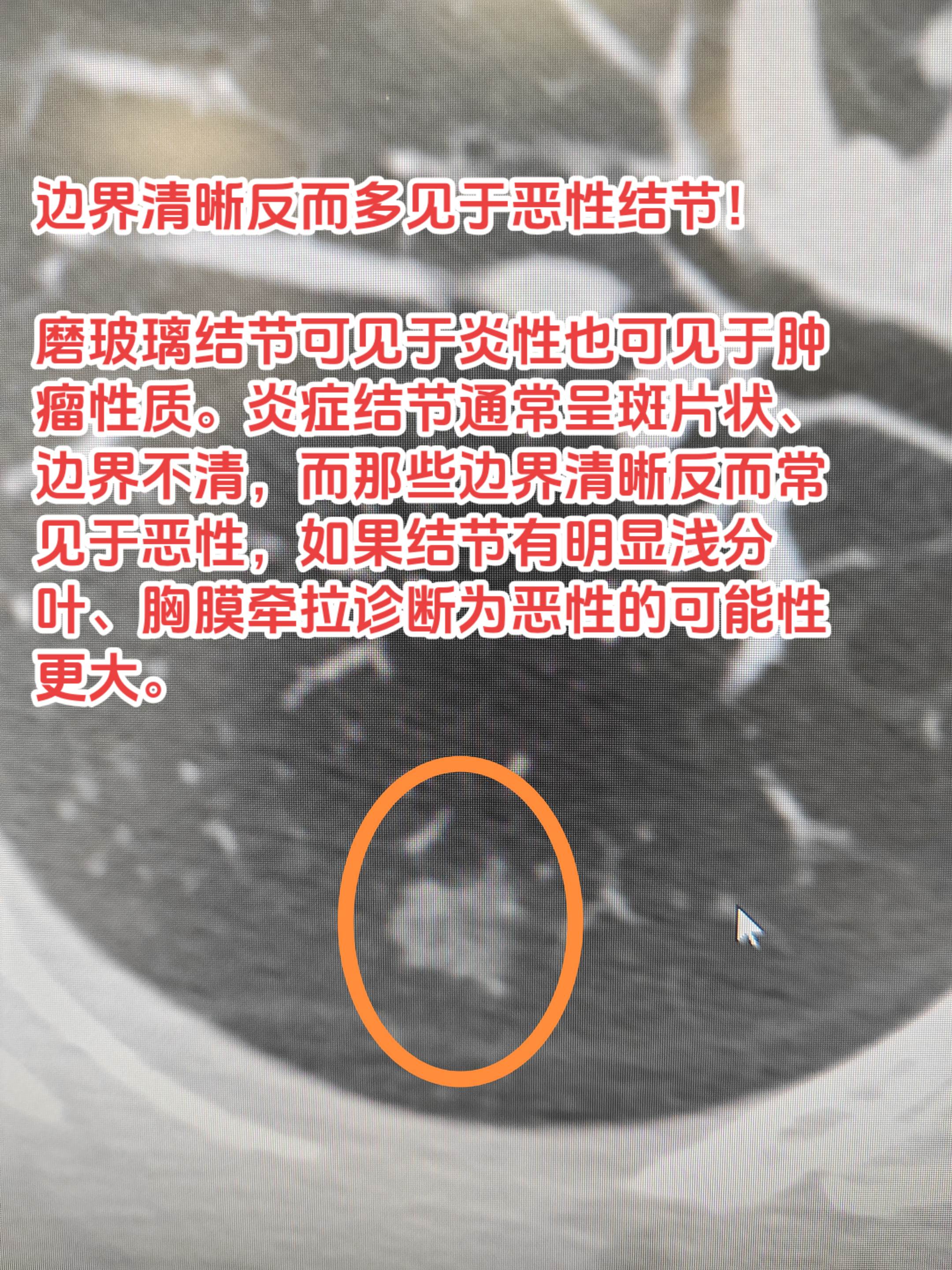 边界清晰反而多见于恶性结节！磨玻璃结节可见于炎性也可见于肿瘤性质。炎症...