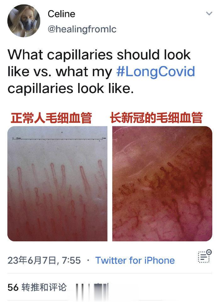 新冠除了几个很弱的抗病毒药，基本等于无药可治，新冠长期后遗症更是无药可治，全身大