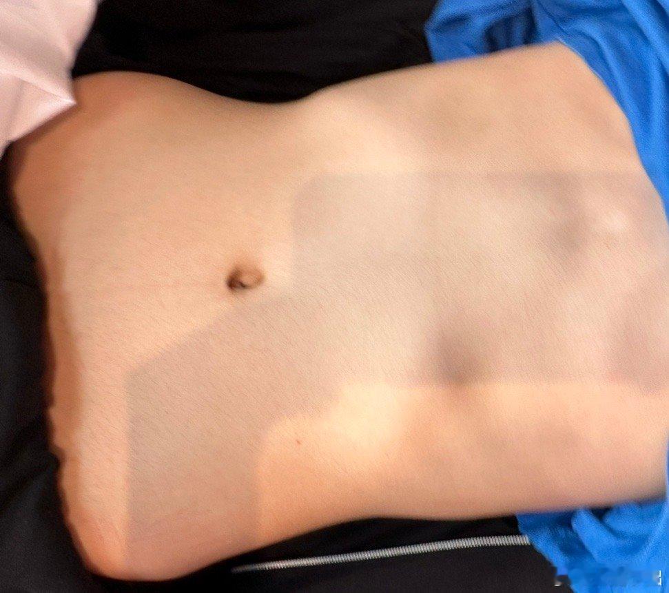 20岁男子的胸腹部，直观看到的是体格瘦小，胸肋凹陷，诊断为精气亏虚。童年时期经常