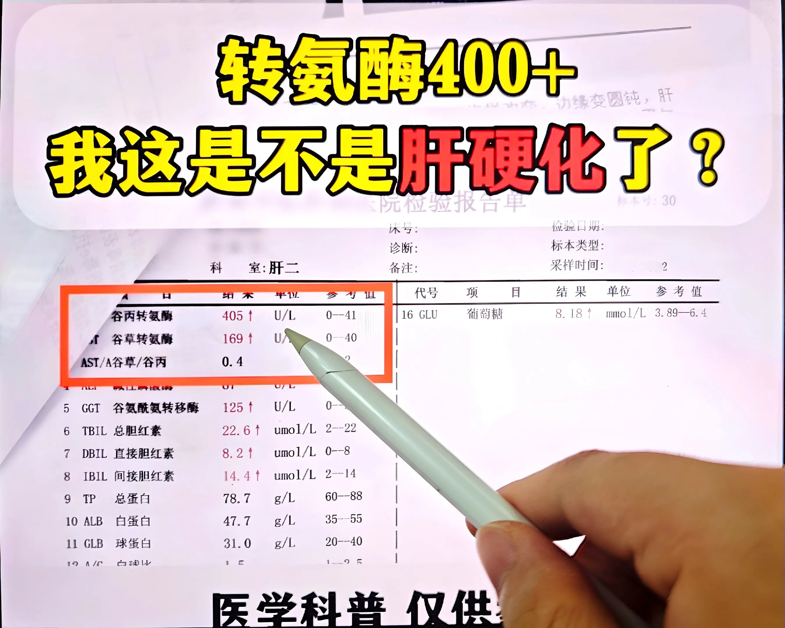 54岁的大兄弟，前年来就诊时便确诊了乙肝，病毒量高达7次方，转氨酶37...