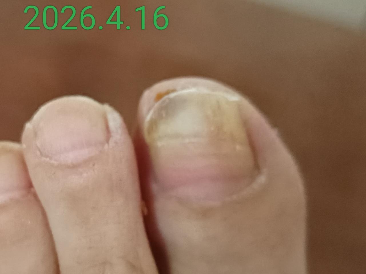 我是确诊整两年的肺腺癌晚期患者。近日复查结果没有癌转移，稍感安慰。不过我个人感觉