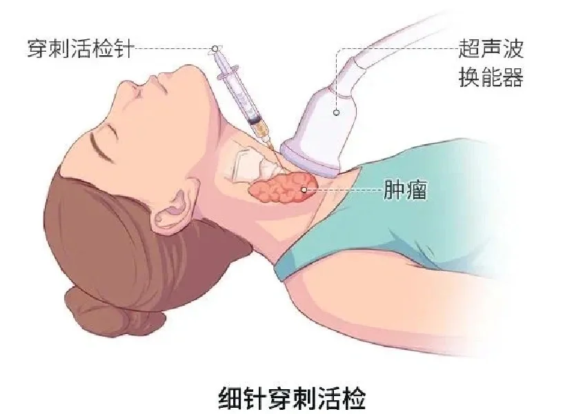 超声引导下甲状腺结节穿刺专家共识2023解读