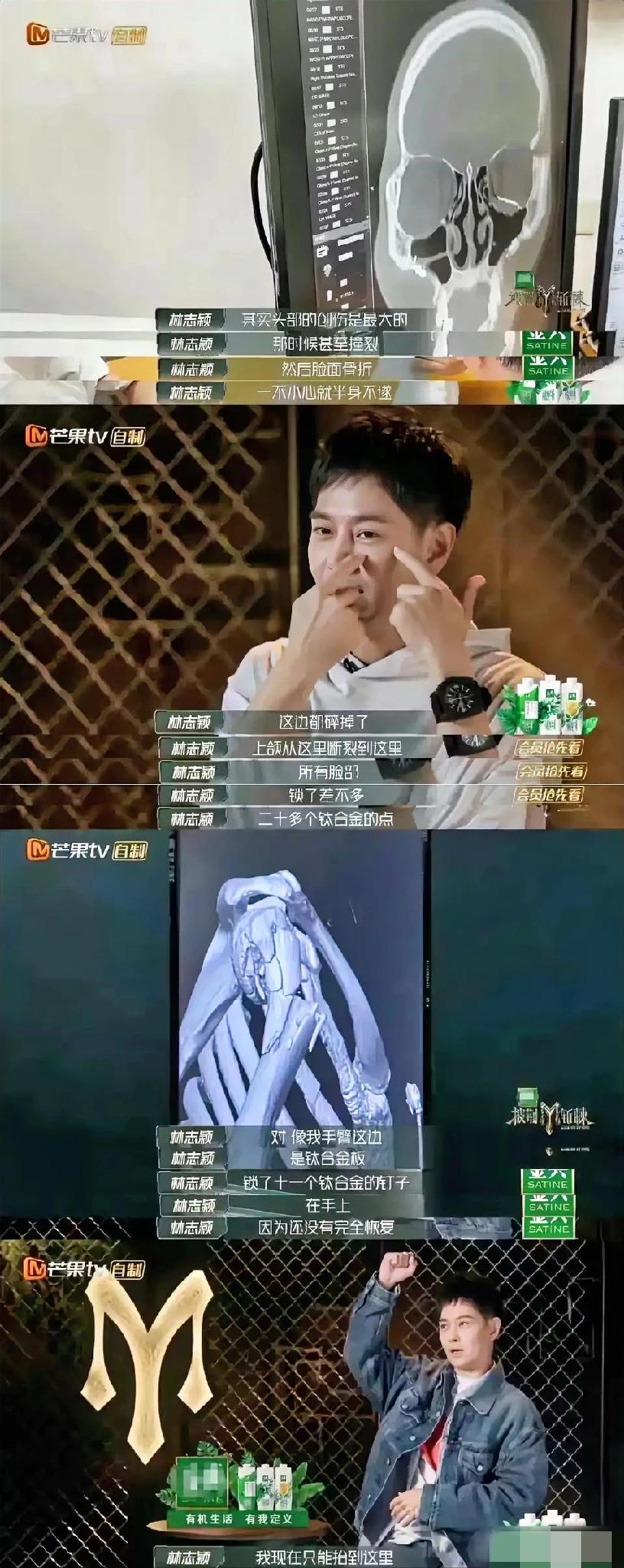 林志颖，
现在的脸上有20个钛合金的点，
手臂上有11个钛合金的钉子，
而且手臂