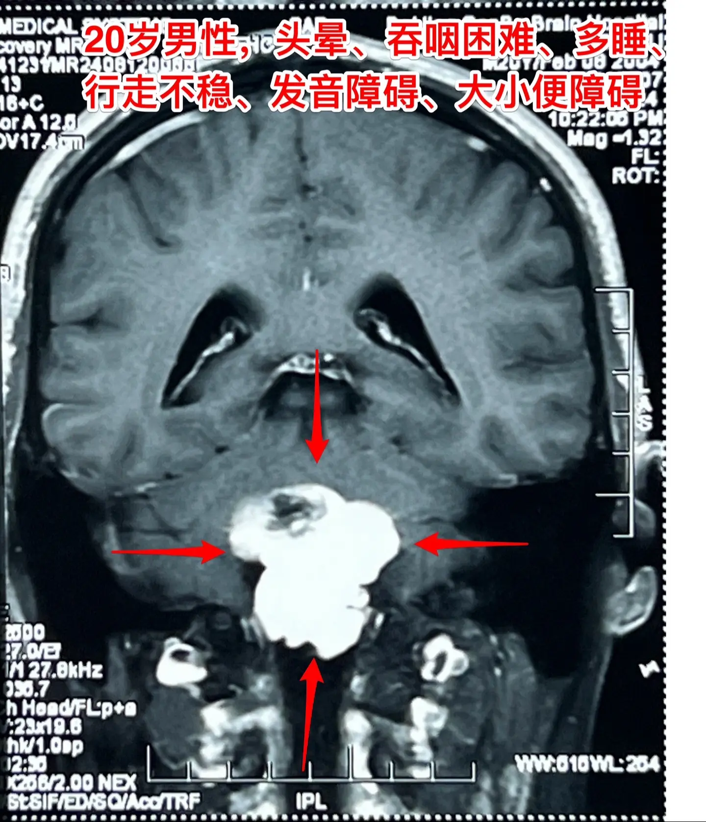 头晕、吞咽困难、行走不稳、大小便障碍。20岁漳州的小伙子，2个月前出现...