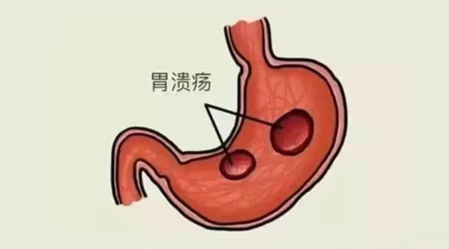 #微博健康公开课##这个问题吃什么##微博健康在关注# 不按时进食，大量胃酸有可