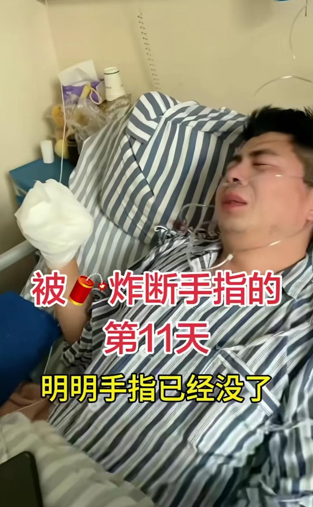 春节就应该禁止燃放烟花爆竹！这哥们儿被鞭炮炸断了手，痛苦不堪！如果不放鞭炮不就没