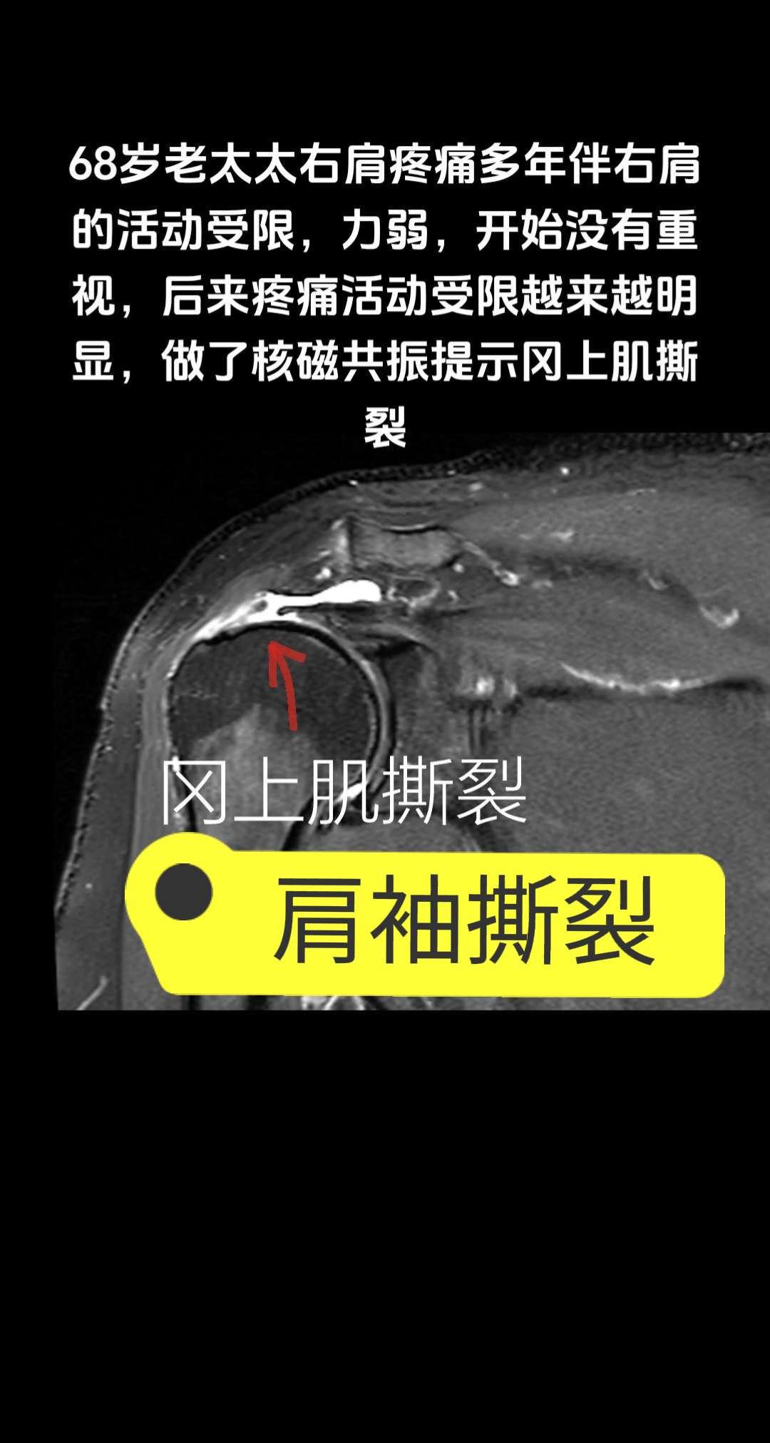 肩袖撕裂。肩袖撕裂要不要手术