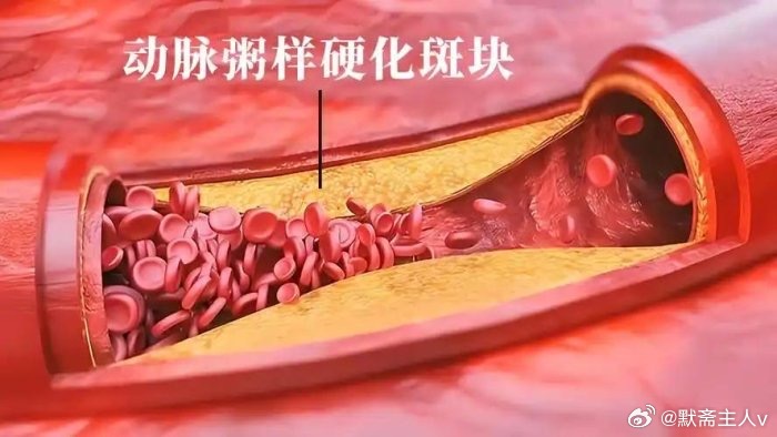 粥饭之间，亦是脑血管的江湖·默斋主人原创科普散文清晨一缕粥香氤氲，悄然映照着血管